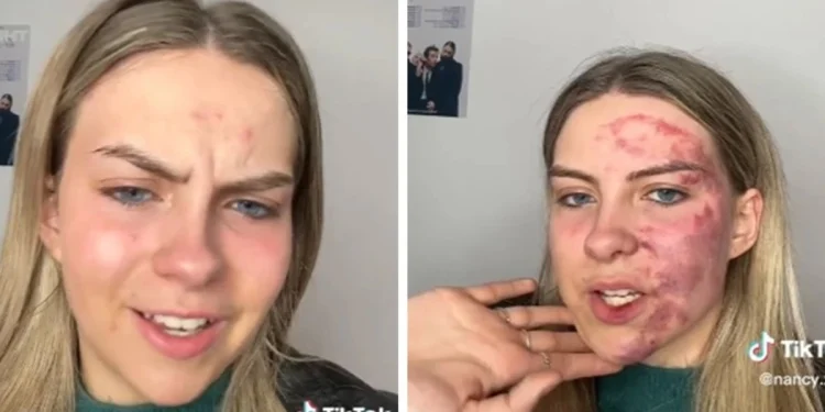 Γυναίκα γέμισε μώλωπες στο πρόσωπο από ένα σπυράκι ‑ Οι γιατροί δεν μπορούν να κάνουν τίποτα