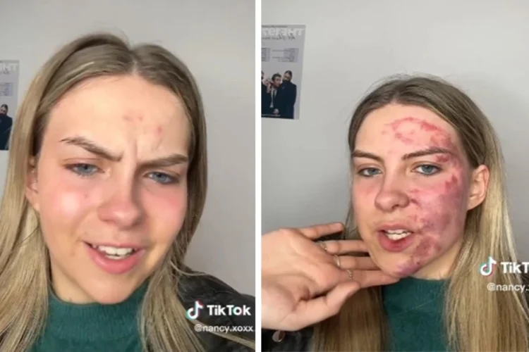 Γυναίκα γέμισε μώλωπες στο πρόσωπο από ένα σπυράκι ‑ Οι γιατροί δεν μπορούν να κάνουν τίποτα