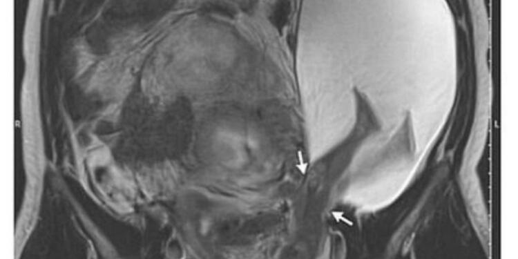 27χρονη έγκυος ήταν έτοιμη να γεννήσει – Όμως αυτό που έκανε το μωρό παραλίγο να της στοιχίσει τη ζωή