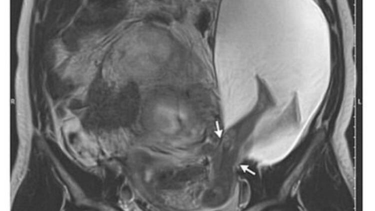 27χρονη έγκυος ήταν έτοιμη να γεννήσει – Όμως αυτό που έκανε το μωρό παραλίγο να της στοιχίσει τη ζωή