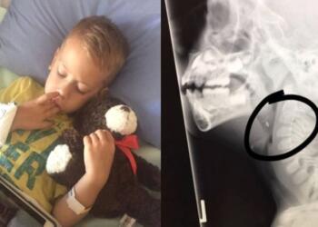 6χρονο αγοράκι έφαγε ένα κοτόπουλο και άρχισε να έχει πόνους στο λαιμό – “Πάγωσαν” όταν είδαν τα αποφάγια