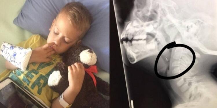6χρονο αγοράκι έφαγε ένα κοτόπουλο και άρχισε να έχει πόνους στο λαιμό – “Πάγωσαν” όταν είδαν τα αποφάγια