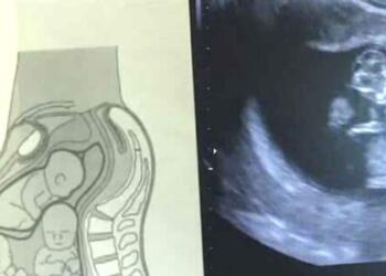 Αυτή η γυναίκα ήταν έγκυος σε τρίδυμα αλλά αυτό που είδαν στον υπέρηχο…Πάγωσε ακόμα και τους γιατρούς!