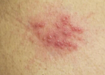 Έρπης ζωστήρας: Συμπτώματα και τι πρέπει να κάνετε