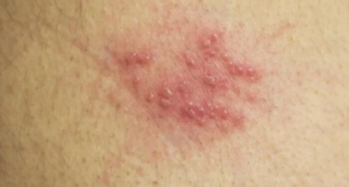 Έρπης ζωστήρας: Συμπτώματα και τι πρέπει να κάνετε