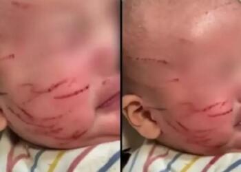 Σοκ Πήρε το μωρό της από τον παιδικό σταθμό και ήταν γεμάτο γρατσουνιές στο πρόσωπο: Η απάντηση που της έδωσαν