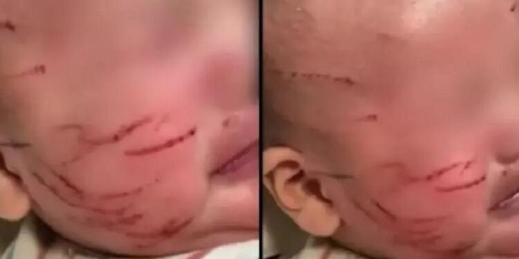 Σοκ Πήρε το μωρό της από τον παιδικό σταθμό και ήταν γεμάτο γρατσουνιές στο πρόσωπο: Η απάντηση που της έδωσαν