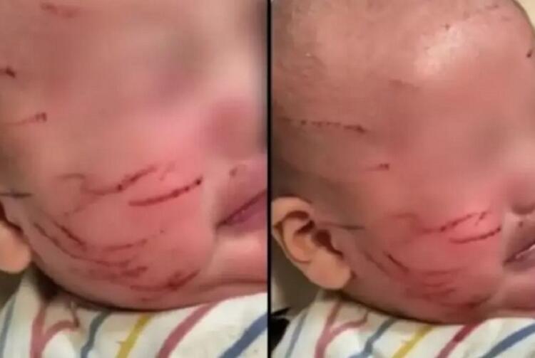 Σοκ Πήρε το μωρό της από τον παιδικό σταθμό και ήταν γεμάτο γρατσουνιές στο πρόσωπο: Η απάντηση που της έδωσαν