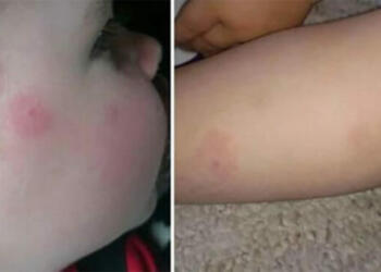Σοκ: Μεγάλη Προσοχή: Ξαφνικά βλέπει εξανθήματα στο δέρμα του γιου της. Ευτυχώς που τον έτρεξε στον γιατρό!