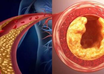 Χοληστερόλη: Το κατακόκκινο φρούτο που «διαλύει» τα λίπη στις αρτηρίες – Δρα σε 60′