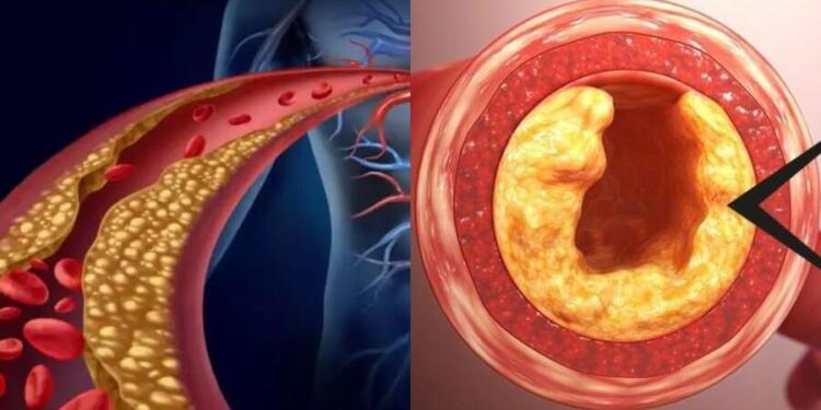 Χοληστερόλη: Το κατακόκκινο φρούτο που «διαλύει» τα λίπη στις αρτηρίες – Δρα σε 60′