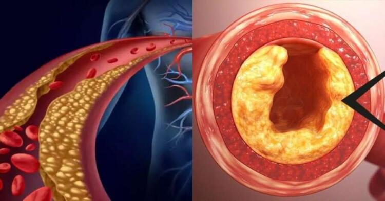 Χοληστερόλη: Το κατακόκκινο φρούτο που «διαλύει» τα λίπη στις αρτηρίες – Δρα σε 60′