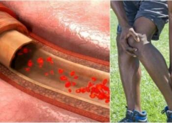 8+1 συμπτώματα που υποδηλώνουν ότι έχετε θρόμβο στο αίμα σας – Ιδιαίτερη προσοχή στο 3ο