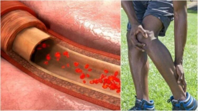 8+1 συμπτώματα που υποδηλώνουν ότι έχετε θρόμβο στο αίμα σας – Ιδιαίτερη προσοχή στο 3ο