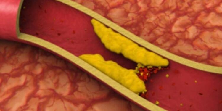 10 τροφές που καθαρίζουν τις αρτηρίες και σε προστατεύουν από καρδιακές επιπλοκές!