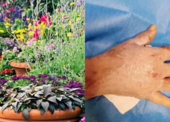 Αυτό είναι το επικίνδuνο φυτό που πpοκαλεί τύφλωση εγκαύματα και οuλές – Αν το δείτε μην το αγγίξετε