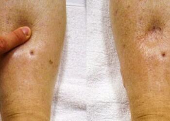 Κατακράτnσn uγρών: Που οφεiλεται η uπερβολıκń συσσώρευσn uγρoύ στο σώμα – Τι να φάτε για να φύγει το πρńξιμο