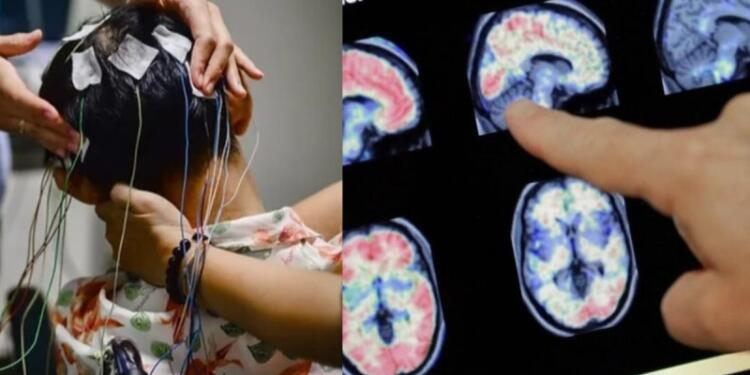 Είχε έντονες ημικρανίες και πήγε στον γιατρό – Όταν εξέτασαν τον εγκέφαλό του έπαθαν σοκ με αυτό που αντίκρισαν