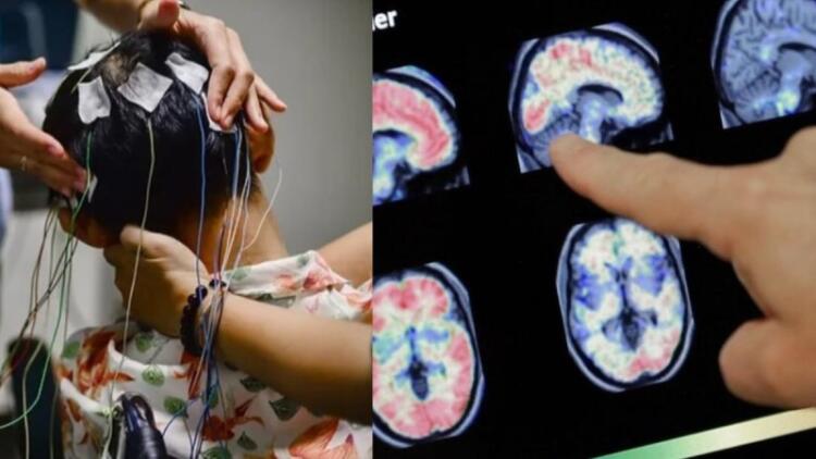 Είχε έντονες ημικρανίες και πήγε στον γιατρό – Όταν εξέτασαν τον εγκέφαλό του έπαθαν σοκ με αυτό που αντίκρισαν