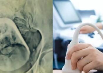 Πήγε στο νοσοκομείο επειδή είχε έντονους πόνους στο στομάχι – Όταν οι γιατροί είδαν τις εξετάσεις του «πάγωσαν» με αυτό που αντίκρισαν