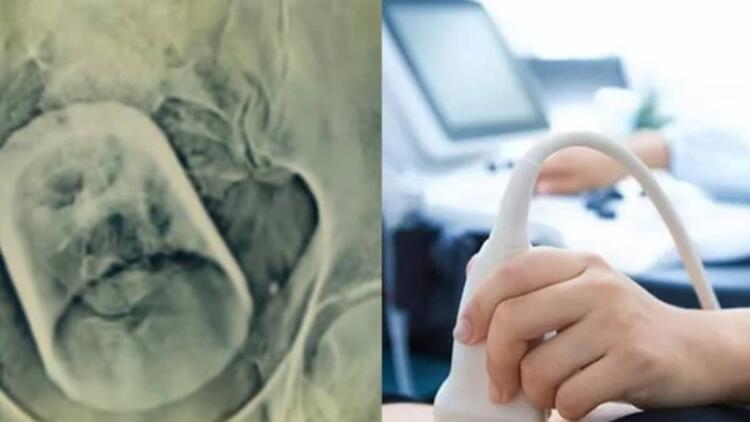 Πήγε στο νοσοκομείο επειδή είχε έντονους πόνους στο στομάχι – Όταν οι γιατροί είδαν τις εξετάσεις του «πάγωσαν» με αυτό που αντίκρισαν