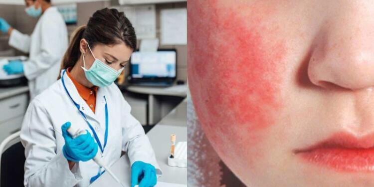 Παρβοϊός: Ποιος είναι ο ιός από τον οποίο έχασε τη ζωή του το 3,5 ετών κοριτσάκι – Τα συμπτώματα και οι τρόποι μετάδοσης