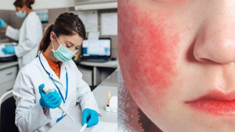 Παρβοϊός: Ποιος είναι ο ιός από τον οποίο έχασε τη ζωή του το 3,5 ετών κοριτσάκι – Τα συμπτώματα και οι τρόποι μετάδοσης