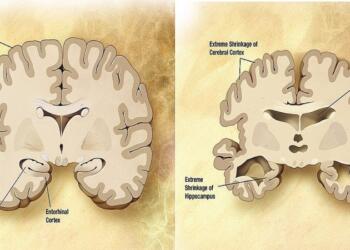 Κερδίζουμε την μάχη του Αλτσχάιμερ – Νέο φάρμακο δίνει ελπίδες – Ποια είναι τα πρώτα συμπτώματα