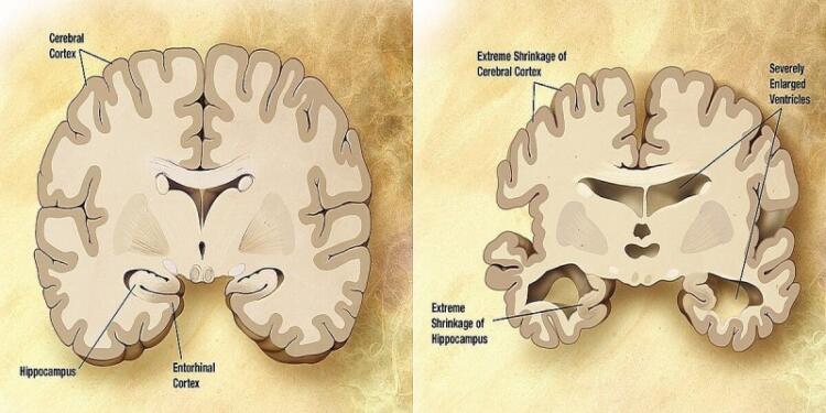 Κερδίζουμε την μάχη του Αλτσχάιμερ – Νέο φάρμακο δίνει ελπίδες – Ποια είναι τα πρώτα συμπτώματα