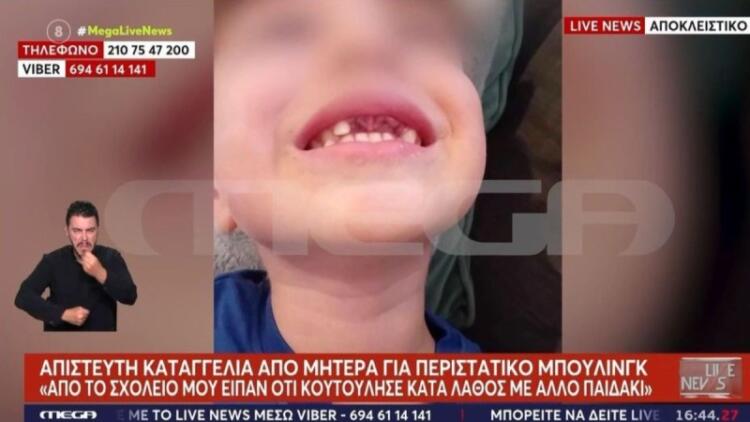 Σοκαριστική καταγγελία: 5χρονα έσπασαν τα δόντια 4χρονου με αυτισμό σε σχολείο – Δε θα μπορεί να φάει για 2 χρόνια