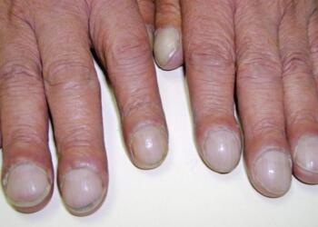 Πληκτροδακτυλία: Τι είναι, πώς προκαλείται, ποια τα συμπτώματα και η θεραπεία – Πότε να καλέσετε γιατρό