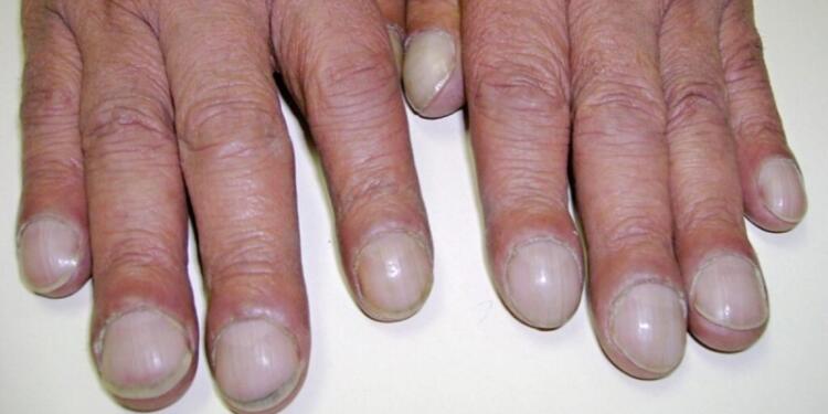 Πληκτροδακτυλία: Τι είναι, πώς προκαλείται, ποια τα συμπτώματα και η θεραπεία – Πότε να καλέσετε γιατρό