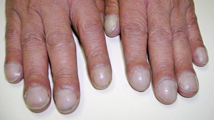 Πληκτροδακτυλία: Τι είναι, πώς προκαλείται, ποια τα συμπτώματα και η θεραπεία – Πότε να καλέσετε γιατρό