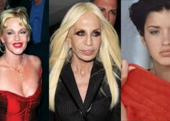 10 διάσημοι που παραμορφώθηκαν μετά από αισθητικές επεμβάσεις