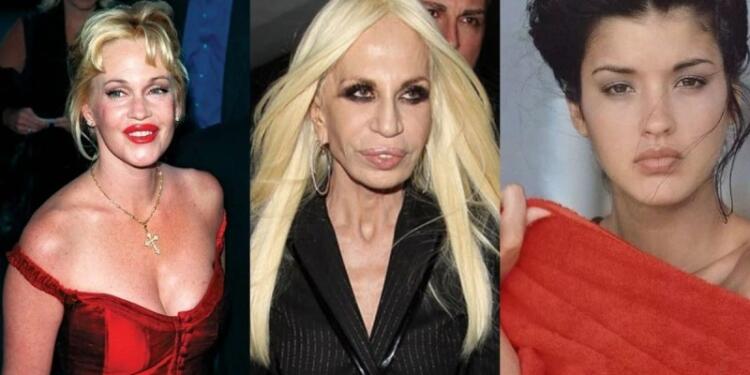 10 διάσημοι που παραμορφώθηκαν μετά από αισθητικές επεμβάσεις