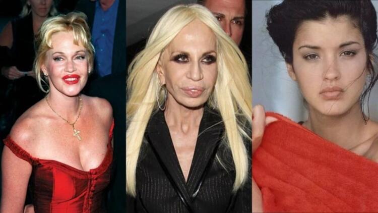 10 διάσημοι που παραμορφώθηκαν μετά από αισθητικές επεμβάσεις