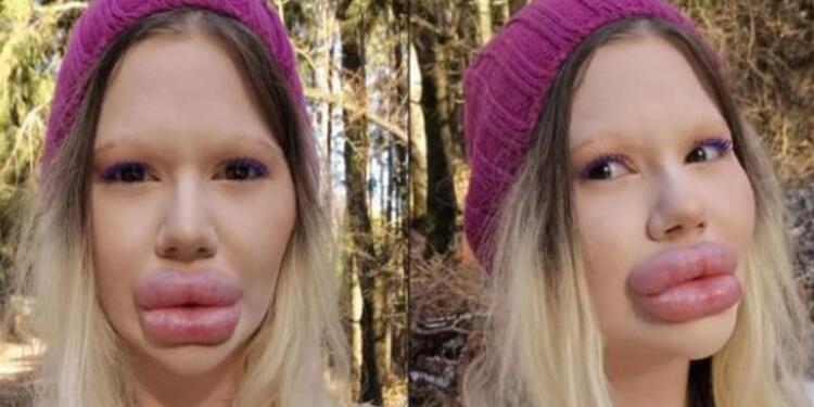 23χρονη πλήρωσε για τα μεγαλύτερα χείλη του κόσμου και οι άντρες κάνουν ουρά για να την παντρευτούν