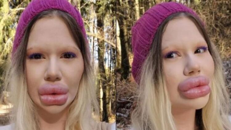 23χρονη πλήρωσε για τα μεγαλύτερα χείλη του κόσμου και οι άντρες κάνουν ουρά για να την παντρευτούν