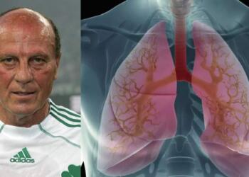 Πνευμονικό οίδημα: Αυτή είναι η αιτία θανάτου του Μίμη Δομάζου! Ποια η αιτία και πως θα το αντιμετωπίσετε;