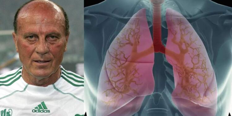 Πνευμονικό οίδημα: Αυτή είναι η αιτία θανάτου του Μίμη Δομάζου! Ποια η αιτία και πως θα το αντιμετωπίσετε;