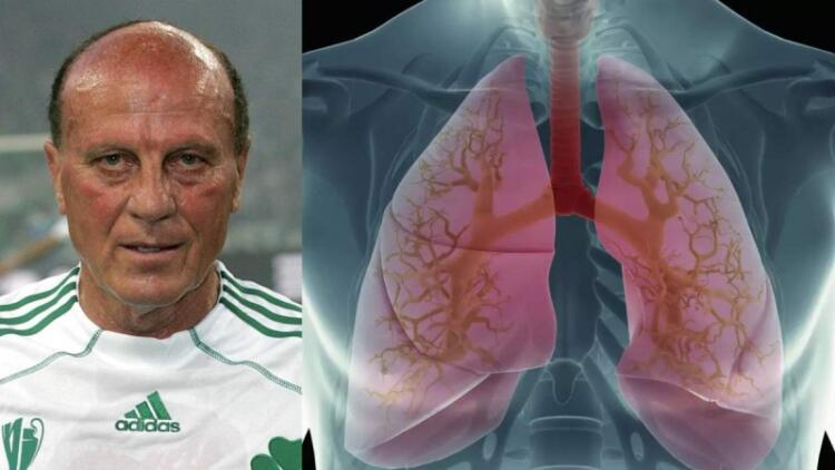 Πνευμονικό οίδημα: Αυτή είναι η αιτία θανάτου του Μίμη Δομάζου! Ποια η αιτία και πως θα το αντιμετωπίσετε;