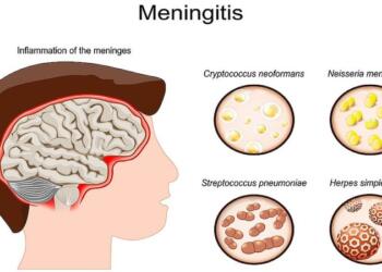 Μηνιγγίτιδα: Πόσα είδη υπάρχουν; Ποια μπορούν να οδηγήσουν στον θάνατο; Προβληματισμός με τον ξαφνικό χαμό 20χρονου φοιτητή στην Πάτρα