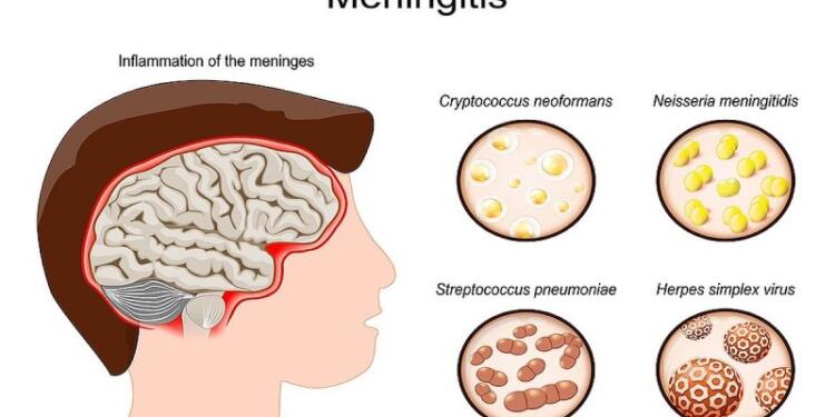 Μηνιγγίτιδα: Πόσα είδη υπάρχουν; Ποια μπορούν να οδηγήσουν στον θάνατο; Προβληματισμός με τον ξαφνικό χαμό 20χρονου φοιτητή στην Πάτρα