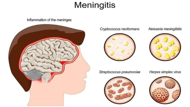 Μηνιγγίτιδα: Πόσα είδη υπάρχουν; Ποια μπορούν να οδηγήσουν στον θάνατο; Προβληματισμός με τον ξαφνικό χαμό 20χρονου φοιτητή στην Πάτρα