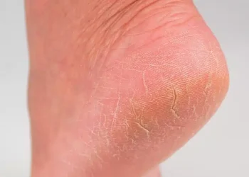 Ξηρές φτέρνες; 4 βήματα για να αποκτήσετε απαλά πέλματα, σαν μωρού