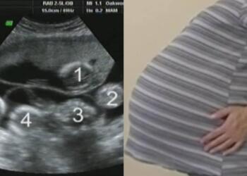 Έγκυος είχε πάει για τον προγραμματισμένο υπέρηχο – Ο γιατρός της είπε κάτι που της κόπηκε η ανάσα!