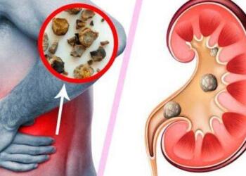 10 Συνήθειες που προκαλούν βλάβες στα νεφρά