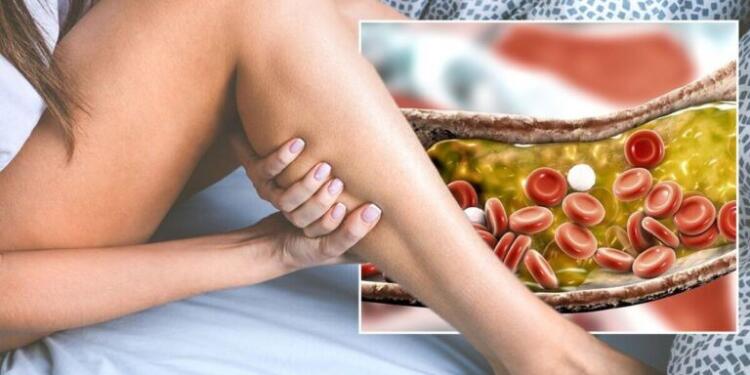 Χοληστερόλη: Τα σημάδια στα πόδια που μαρτυρούν ότι είναι στα ύψη