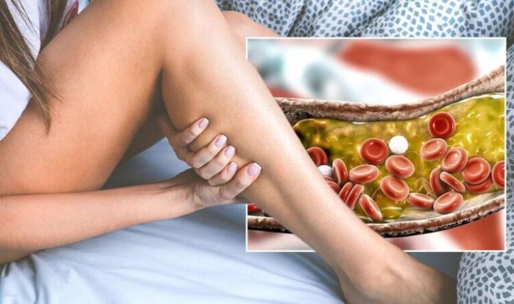 Χοληστερόλη: Τα σημάδια στα πόδια που μαρτυρούν ότι είναι στα ύψη