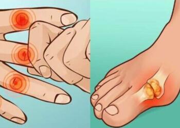 Ουρικό οξύ: Πόσο επικίνδυνη είναι-Τι να φάτε για να ρίξετε το ουρικό οξύ- Ποιες τροφές να αποφύγετε